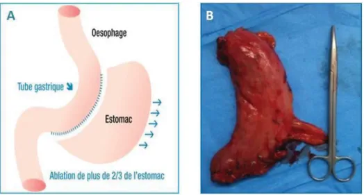 Figure 6.  Schéma illustratif de l’opération de sleeve gastrectomie et photo de  l’estomac réséqué 