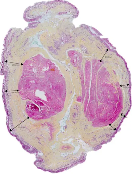Figure 10.  Mesure de la distance entre la membrane basale et le muscle lisse  bronchique (µm)