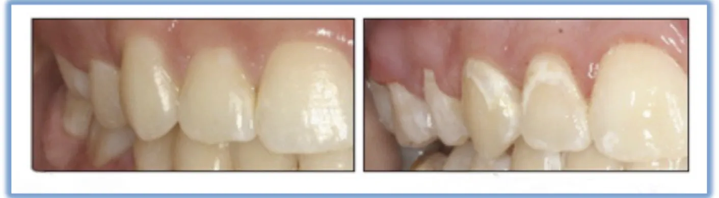 Figure 9.  Exemple de déminéralisations (61) . 