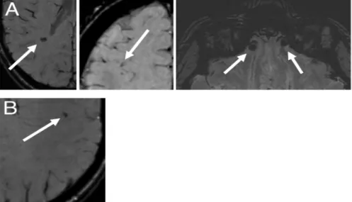 Figure 1. Possible micro-hemorrhages in participants. 