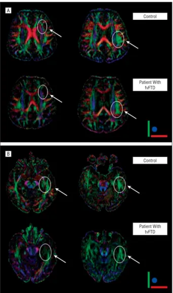 Figure 2. Diffusion tensor imaging red-green-blue maps in a representative control subject and patients with frontal variant and temporal variant of frontotemporal dementia (fvFTD and tvFTD, respectively), illustrating the selective fiber tract changes