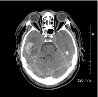 Figure 1. CT scan at admission 