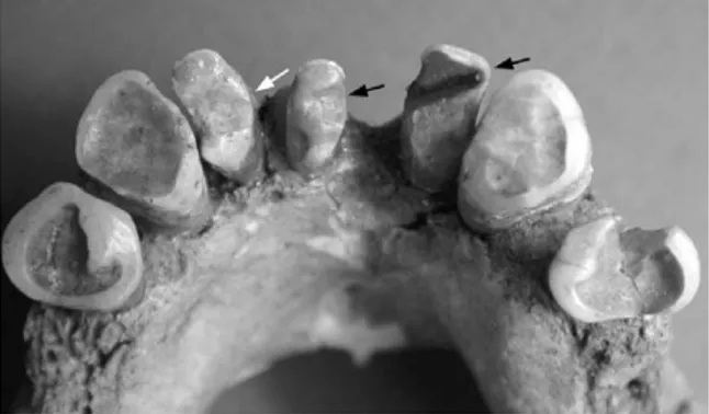 Fig. 1 . H92 : Partie antérieure de la mandibule, vue supérieure. Les flèches indiquent la position et l’orientation des sillons.
