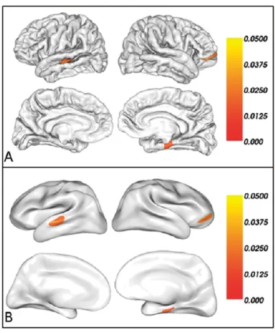 Figure  1-4.  Régions  cérébrales  d’épaisseur  corticale  plus  élevée  chez  les  sportifs  :  le  sulcus  temporal supérieur gauche (en haut à gauche A et B), le cortex orbitofrontal droit (en haut à  droite A et B) et le gyrus parahippocampal droit (en
