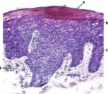 Figure  16.  Coupe  histologique  de  la  peau  psoriasique.  La  lésion  est  caractérisée  par  une  parakératose (a), une acanthose (b), des extensions épidermiques vers le derme (c), ainsi que  d’infiltrat de cellules mononuclé ées au niveau du derme p