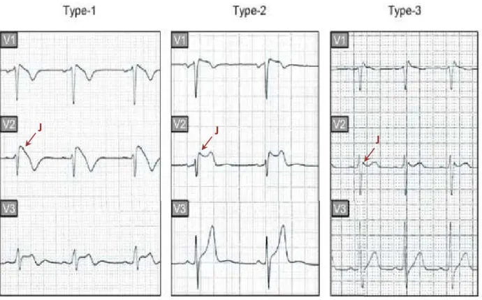 Figure 9 : Aspects  électrocardiographiques  typiques  du  syndrome  de  Brugada  observés  dans les dérivations précordiales droites