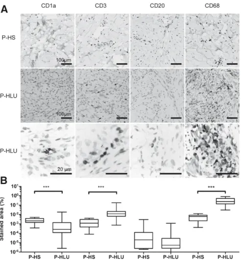 Figure 4 Leukocyte immunolabeling of paraf ﬁ n-embedded tissues from P-HS and P-HLU that constitute the TMA (n Z 8, 4 samples per tissue)