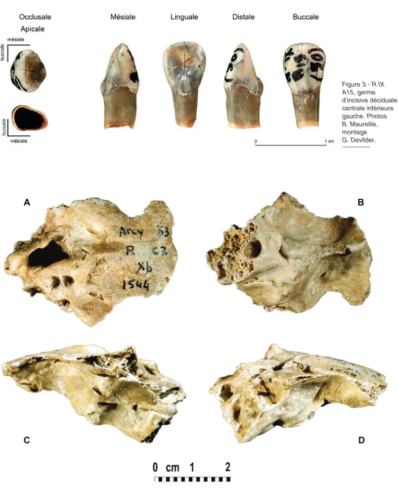 Figure 3 - R IX  A15, germe  d’incisive déciduale  centrale inférieure  gauche. Photos  B