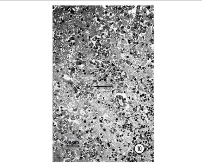 Figure 16 : Encéphalite amibienne à Balamuthia (Schuster and Visvesvara, 2004). 