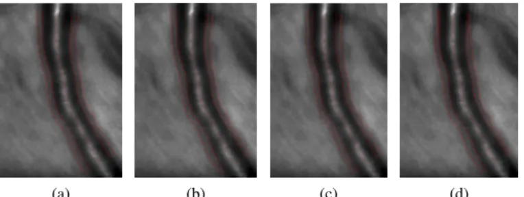 Figure 4: Benefit of using a presegmentation with varying half- half-diameters (a),(b) against constant ones (c),(d) for a  pathologi-cal case