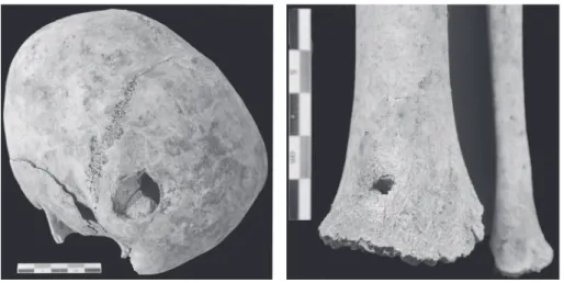 Fig. 9. Perforation transversale du tibia au- au-dessus de la cheville (crédit V. Gallien, Inrap).