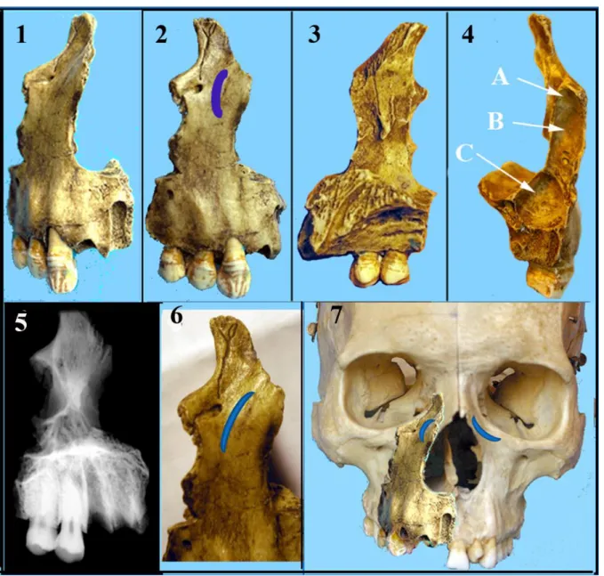 FIGURE 5. — La partie de maxillaire du Coup-Gorge. 1,2,6, vue externe avec le boursouflement peri-nasal
