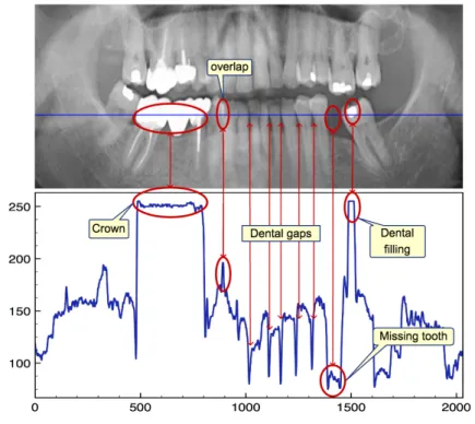 Figure 5: A panoramic radiograph, with a 1D profile below. The Profile of the blue line is plotted as a 1D plot.