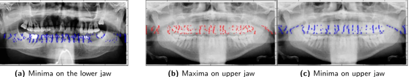 Figure 7 shows how it is possible to detect local minimas along the columns in order to seek for the gap between the upper and lower jaws (resp