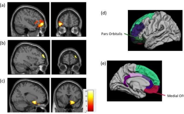 Figure  1.  Smaller  prefrontal  cortex  volumes  in  adolescents  with  high  levels  of  harsh  parenting, compared to those with low levels of harsh parenting