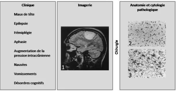 Figure 3 : Approche multidisciplinaire conduisant au diagnostic d’une tumeur cérébrale  Certains signes cliniques caractéristiques, associés à des données d’imagerie (1, IRM), peuvent conduire à une  intervention  chirurgicale  pour  biopsie  ou  exérèse