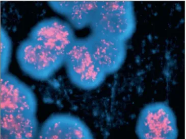 Figure 3  : Amplification de l’oncogène MYCN dans des noyaux de cellules de  neuroblastome mise en évidence par la technique de FISH (fluorescent in situ  hybridation) (d’après Maris et al., 2007)