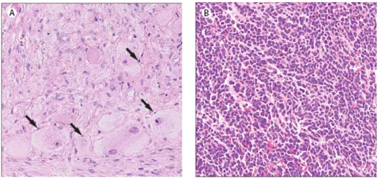 Figure 5 : Histologie de coupes de tumeurs neuroblastiques (tiré de Maris et al., 2007)