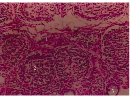 Figure 4. Bourse de Fabricius infectée par IBDV à 1 semaine d’âge. Nécrose de la BF  (1); prolifération des lymphocytes T (2); formation de kyste dans l’épithélium (3) 