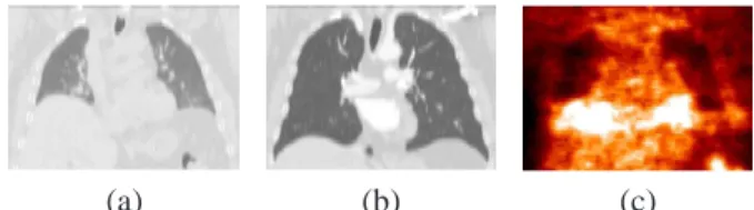 Figure 1. Corresponding views of the same patient in CT (a)–(b) for two instants of the breathing cycle, and PET (c).