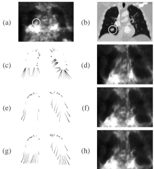 Figure 6. Original PET (a) and CT (b) images with tumor (surrounded by a white circle)