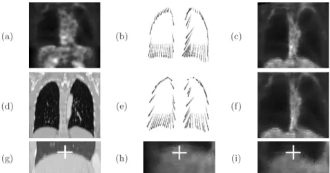 Fig. 4. (a) Original PET, (d) CT images in a normal case. Correspondences between selected points in the PET image and in the CT image are shown in (b) for the direct method and (e) for the method with the breathing model (corresponding points are linked)
