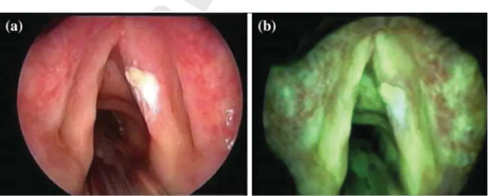 Fig. 2 Vocal folds endoscopic images: a white light endoscopic image, b fluorescence endoscopic image [18]