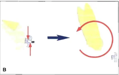 Figure  2.4 :  Exemple clinique d'un couple; engagement  d'un fil rectangulaire dans la  lumière d'un boîtier préajusté  avec une prescription de torque (Nanda, 2005)