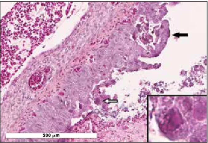 Figure 2.  Bronchus of an affected duckling. There is hyperplasia  and squamous metaplasia of the epithelium, infiltration by  heterophils, and degeneration/necrosis and sloughing of  individual to small groups of epithelial cells (black arrow)