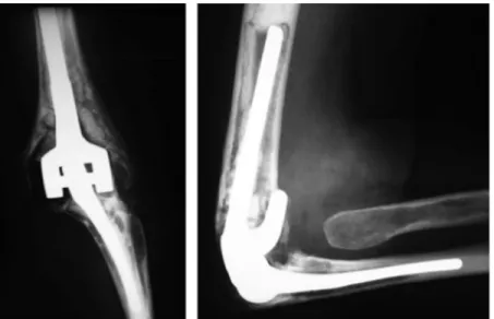 Figure 3 (A) Elbow radiographs, anteroposterior and lateral views of the ulnar component fracture