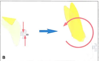 figure 2.2 t Keniple clinique d’un couple; engagement d’un fit rectangulaire dans la lumière d’un boîtier préajusté avec une prescription de torque (Nanda, 2005).