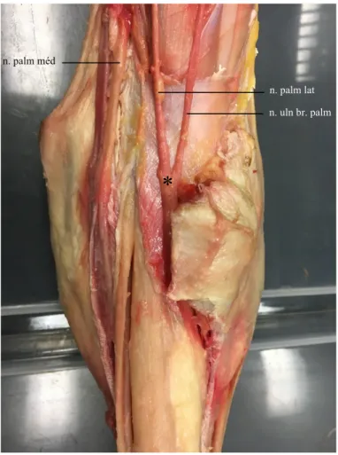 Figure 3 : Dissection longitudinale de la face  palmaire  d’un  membre  thoracique  droit