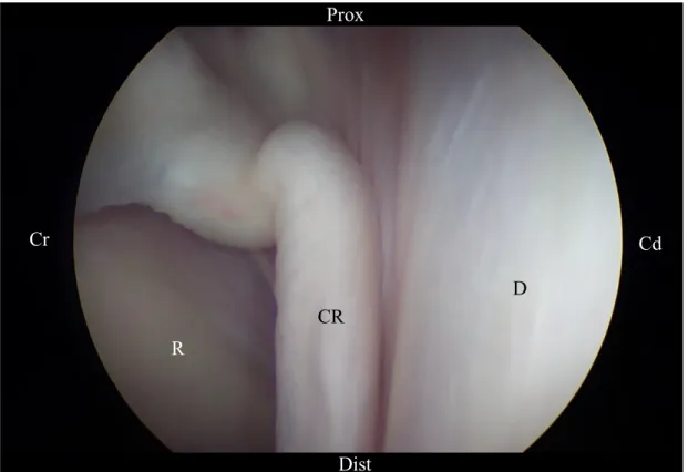 Figure 6 : Vue ténoscopique de la gaine carpienne avec un portail proximo-latéral et  l’arthroscope orienté proximo-médialement