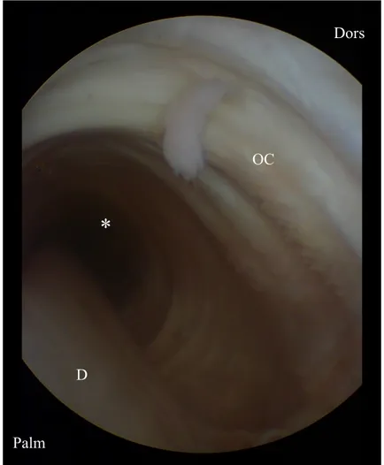 Figure  8 :  Vue  ténoscopique  de  la  gaine  carpienne  avec  un  portail  proximo-latéral  et  l’arthroscope orienté distalement