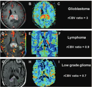 Figure 1.8: Diﬀerentiation between 3 types of brain tumours: glioblastoma, lym- lym-phoma and low-grade glioma using the complementarity of T1w-Gd and perfusion imaging