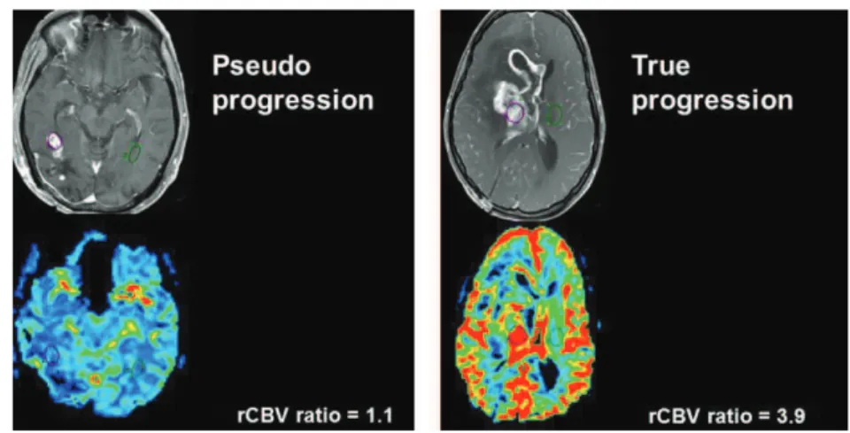 Figure 1.10: Diﬀerentiation between post-radiation necrosis (pseudo-progression) and tumour recurrence (true progression) using perfusion imaging