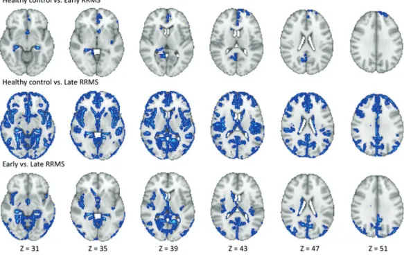 Figure 1.  Comparison of myelin volume fraction (MVF) obtained from synthetic quantitative MRI between  healthy controls and early and late relapsing-remitting multiple sclerosis (RRMS) patients