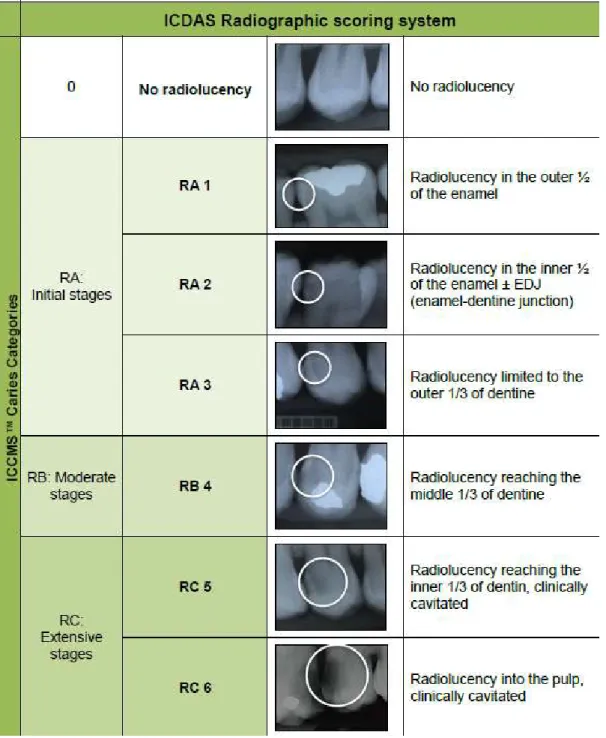 Figure 3 : Définition et caractéristiques radiologiques des lésions carieuses selon le  ICCMS  