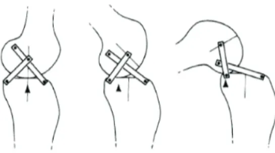 FIGURE 1. Representation of the human knee joint composed of a four-bar linkage. Illustration of the posterior translation of the contact point between the femur and the tibia.