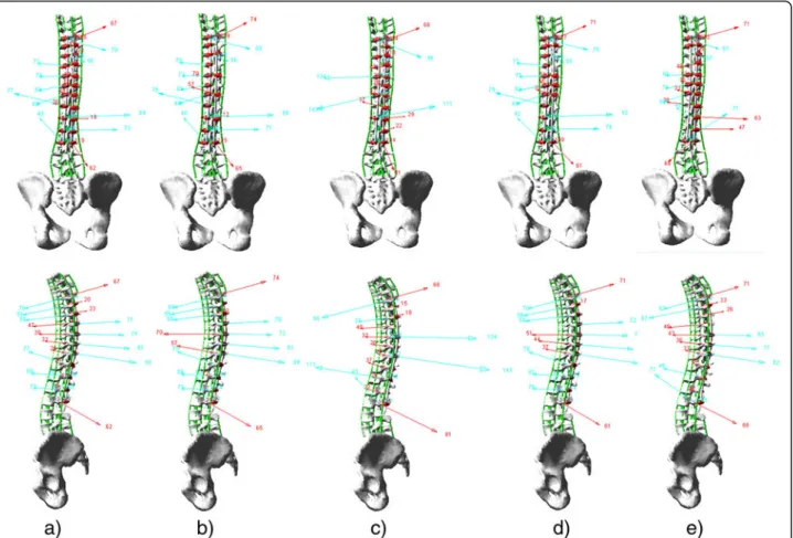 Fig. 6 Posteroanterior and lateral views of the preoperative spine models, major curve Cobb angles and the average bone-screw forces with bilateral screws at each level fused