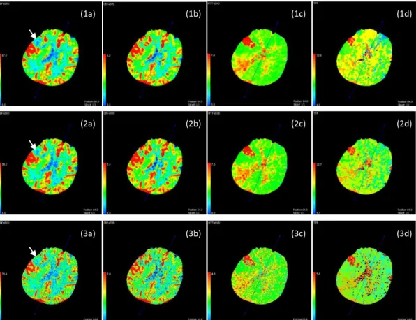 Fig. 6 Perfusion maps of the selected patient. Three rows are maps calculated from ground truth CTP,  15-pass CNN restored results, and unprocessed 15-pass CTP respectively
