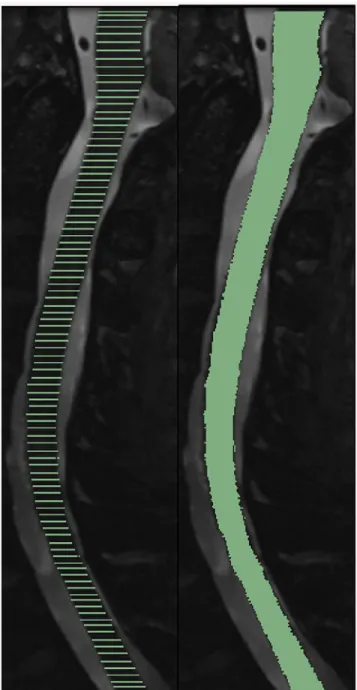 Fig 5. A mid-sagittal semi-automatically segmented image at 100 points along the Z-axis shown before (left) and after interpolation (right).