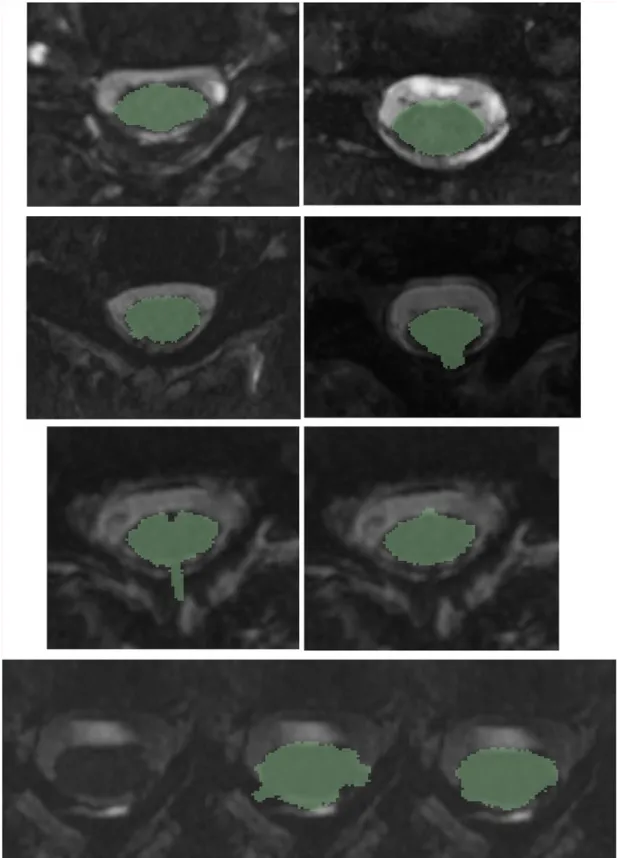 Fig 6. Examples of difficult segmentations due to reduced CSF, artifacts, and spinal rootlets