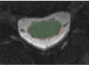 Fig 7. Example of the difference between two raters segmentation of a smoothed T2-weighted MR image