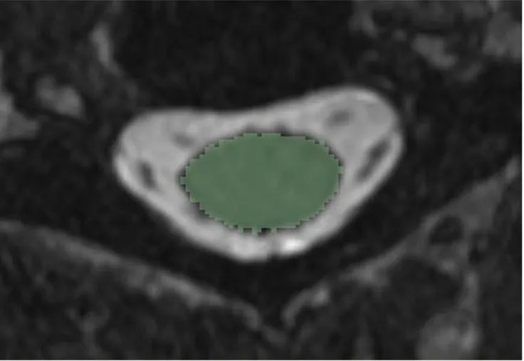 Fig 1. One manually segmented axial slice of a MR image. This image was shown to the raters to instruct them on how to manually segment the spinal cord.