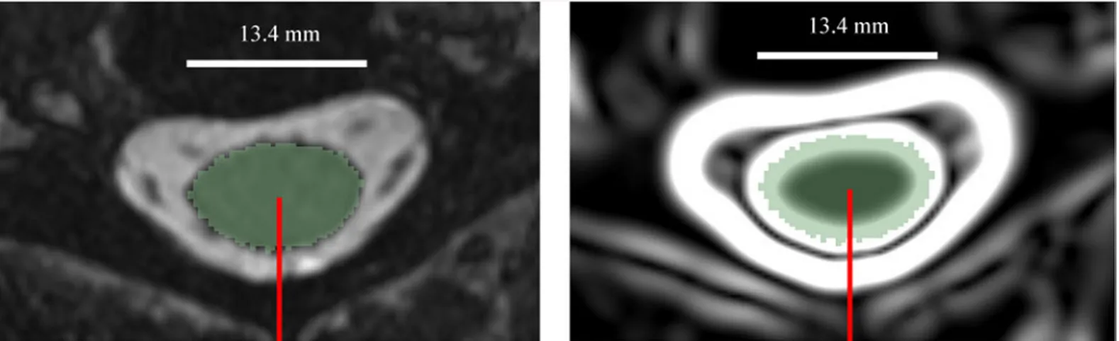 Fig 2. An axial slice of the MR image (left) and the gradient image (right) of the cervical spinal cord
