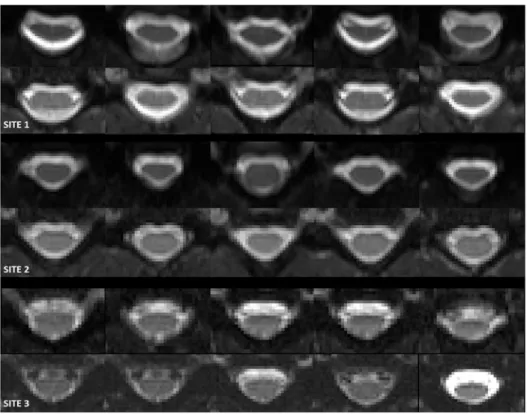 Fig 1. Anatomical images centred at levels C3/C4, similarly to the images shown in Figs 2 and 3, for an example single subject (not the same subject at each of the three sites) acquired at each of the 3 sites (London, Vanderbilt and Montreal; 1 – 3 from to