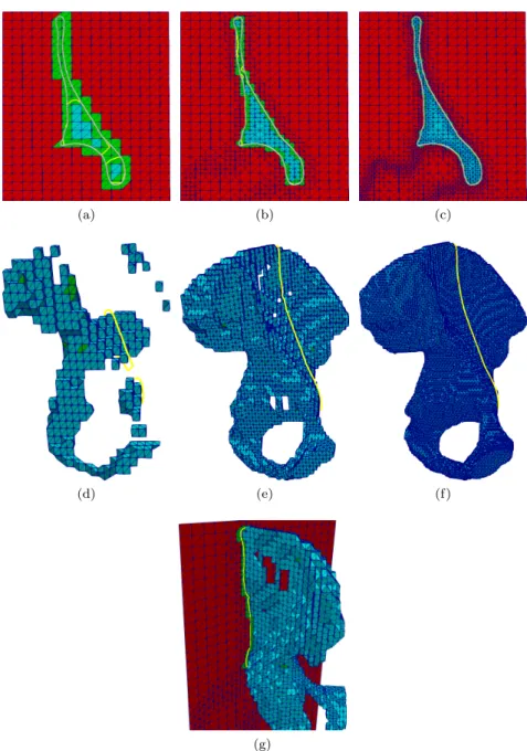 Figure 6: Linear approximation of the hip bone surface triangulation in regular background mesh with two refinement steps of all elements which collide with the surface triangulations of the hip and femur bone