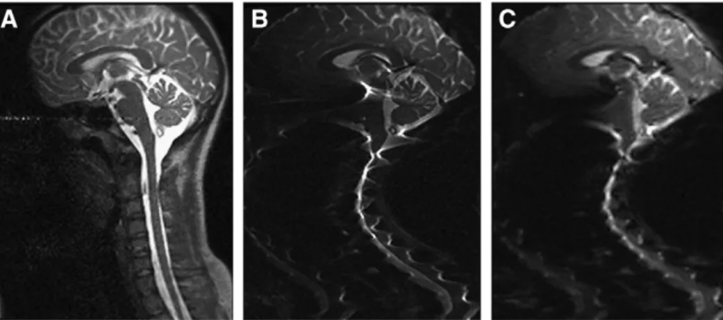 Fig. 1. Spatial distortions caused by bone/tissue interfaces in the spine with A) a half-Fourier single-shot fast spin-echo (HASTE), B) a spin-echo EPI, and C) a gradient-echo EPI im- im-aging sequence.