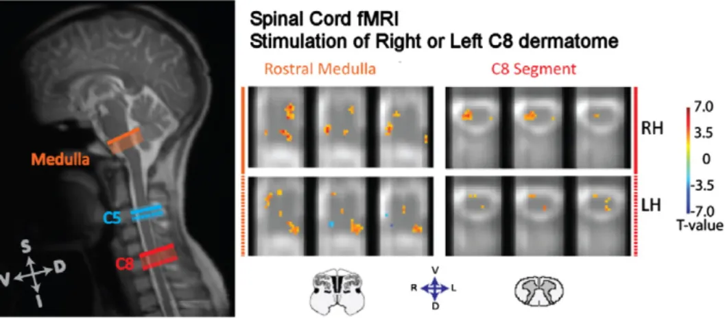 Fig. 2. An example of spinal cord and brainstem fMRI results obtained from a group of healthy participants, with thermal stimulation of the right and left hands